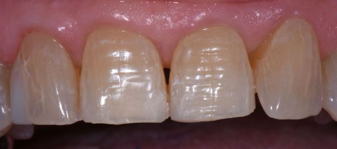 Tooth-colored Fillings: Case 5 - Halletsville, TX - After