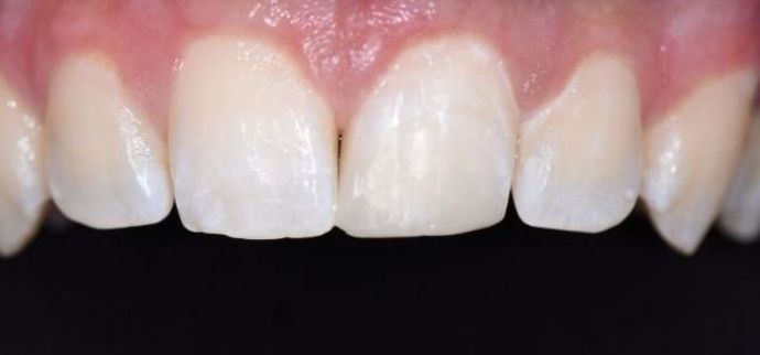 Tooth-colored Fillings Case 6 - Shiner, TX - After