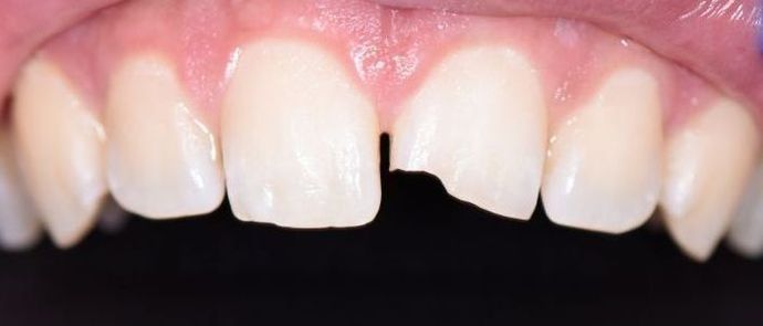Tooth-colored Fillings Case 6 - Shiner, TX - Before