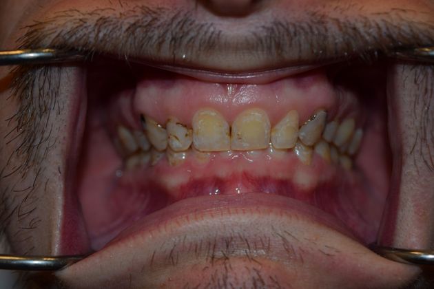 Smile Makeover 8 VENEERS (case 3) - Before