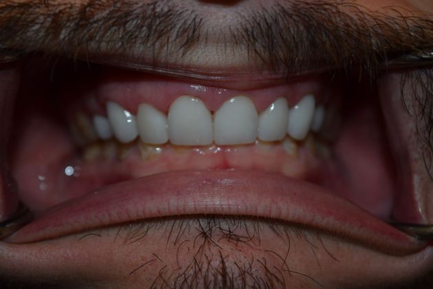 Smile Makeover 8 VENEERS (case 3) - After