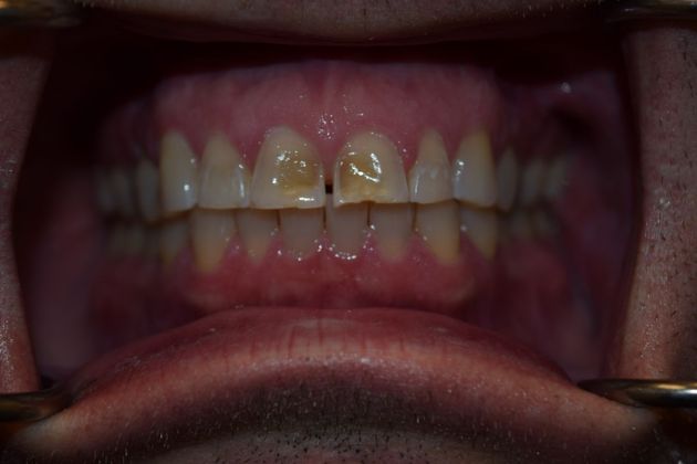 Smile Makeover 4 VENEERS (case 2) - Before