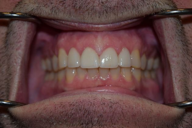 Smile Makeover 4 VENEERS (case 2) - After