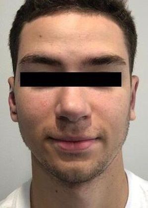 Otoplasty Case 6 - Otoplasty, Darien - After