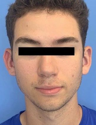 Otoplasty Case 6 - Otoplasty, Darien - Before