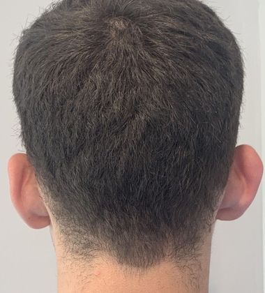 Otoplasty: Case 6 - Otoplasty, Darien - Before