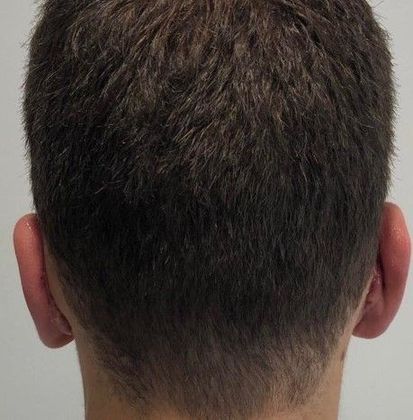 Otoplasty: Case 6 - Otoplasty, Darien - After