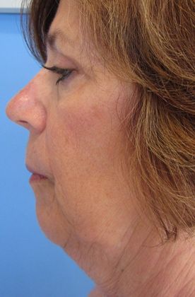 Facelift: Case 19 - Facelift Trumbull - Before