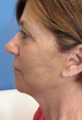 Facelift: Case 19 - Facelift Trumbull - After