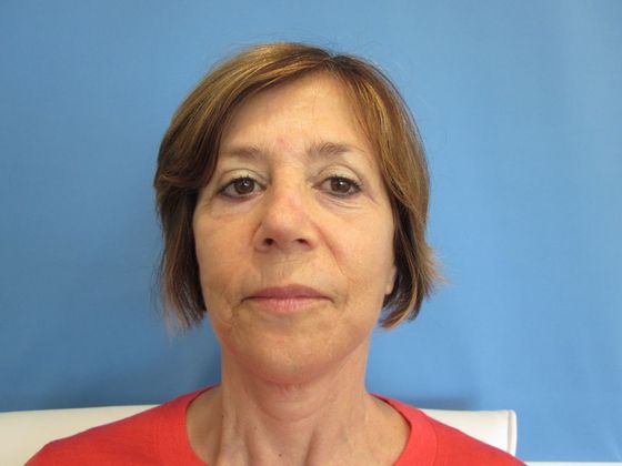 Facelift: Case 19 - Facelift Trumbull - After