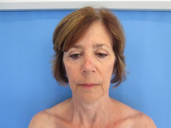 Facelift: Case 19 - Facelift Trumbull - Before