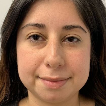 Rhinoplasty: Case 15 - Rhinoplasty Waterbury, CT - Before