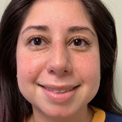 Rhinoplasty: Case 15 - Rhinoplasty Waterbury, CT - After