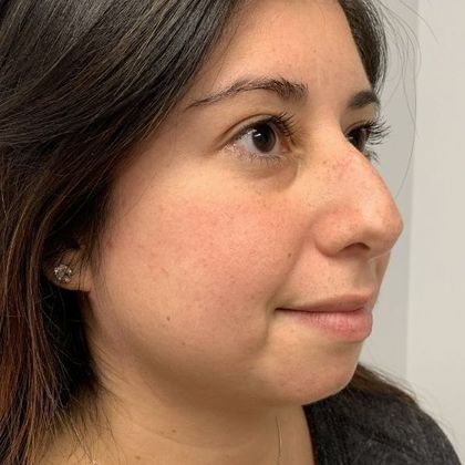 Rhinoplasty Case 15 - Rhinoplasty Waterbury, CT - Before