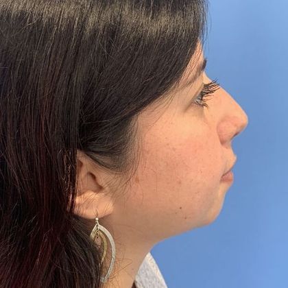 Rhinoplasty Case 15 - Rhinoplasty Waterbury, CT - After