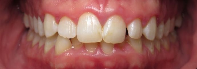 Braces Case 1 - Victoria, TX - Before