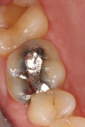 Crowns Case 1 - Victoria, TX - Before