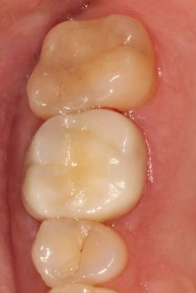 Crowns Case 1 - Victoria, TX - After