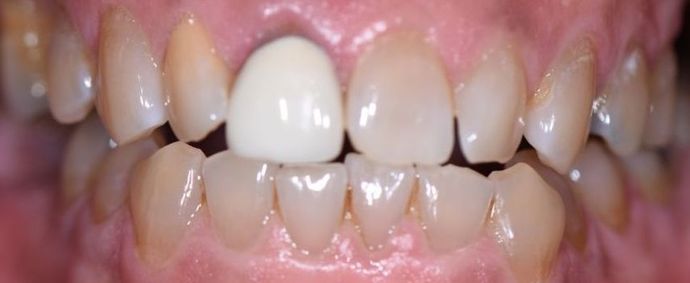 Crowns: Case 2 - Edna, TX - Before