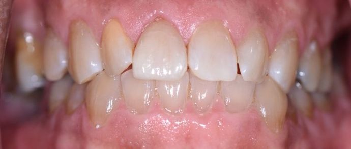 Crowns: Case 2 - Edna, TX - After