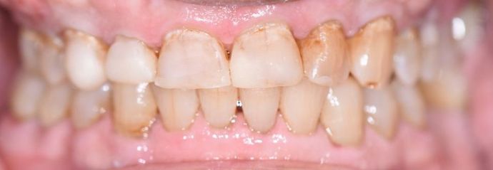 Full Mouth Reconstruction Case 1 - Victoria, TX - After