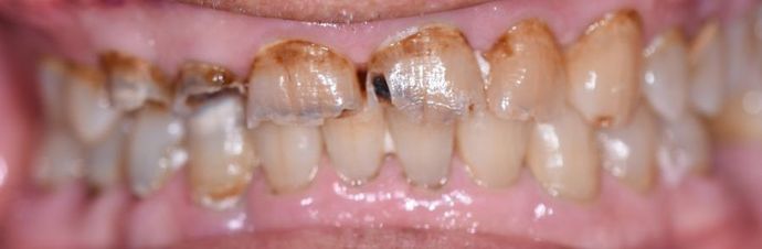 Full Mouth Reconstruction Case 1 - Victoria, TX - Before