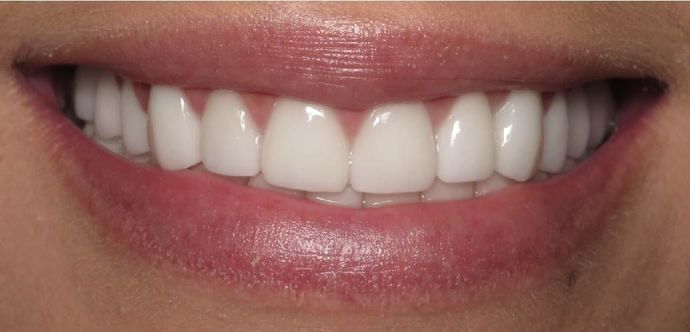 Porcelain Veneers: Case 1 - Victoria, TX - After