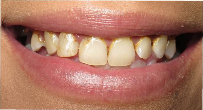 Porcelain Veneers: Case 1 - Victoria, TX - Before