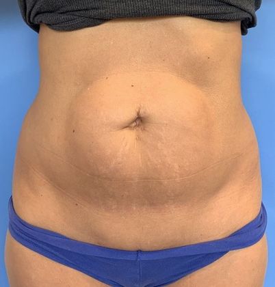 Liposuction Case 13 - Liposuction Norwalk, CT - Before