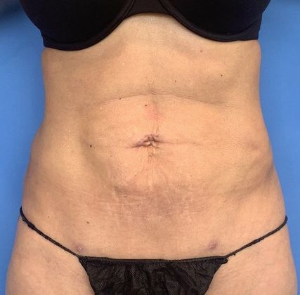 Liposuction Case 13 - Liposuction Norwalk, CT - After