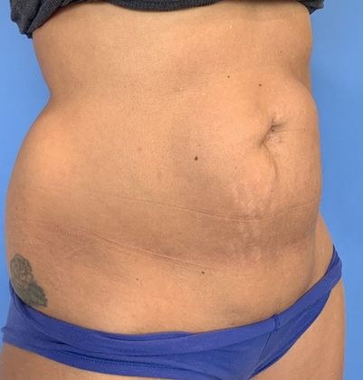 Liposuction: Case 13 - Liposuction Norwalk, CT - Before