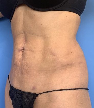 Liposuction: Case 13 - Liposuction Norwalk, CT - After