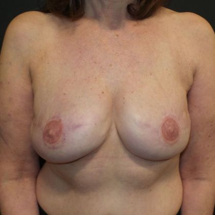DIEP Flap Breast Reconstruction Case 29 - After