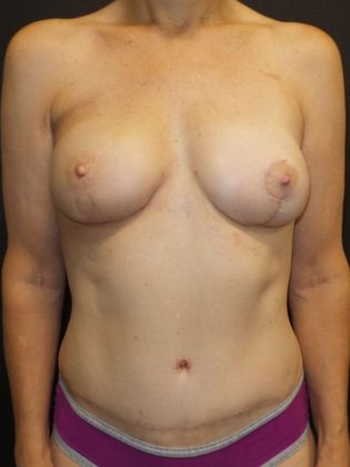 DIEP Flap Breast Reconstruction: Case 33 - After