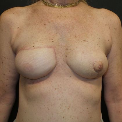 DIEP Flap Breast Reconstruction: Case 43 - After