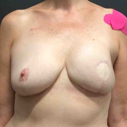 DIEP Flap Breast Reconstruction: Case 46 - After