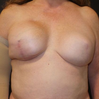 DIEP Flap Breast Reconstruction Case 47 - Before