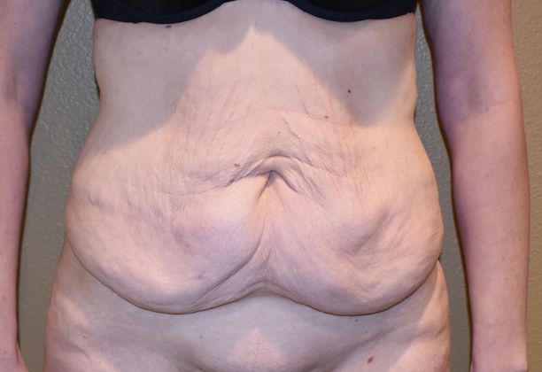 Tummy Tuck (Abdominoplasty) Case 196 - Before
