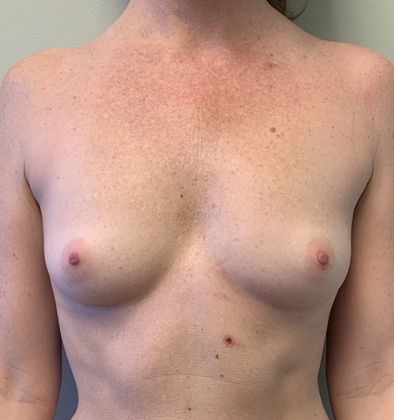 Breast Augmentation: Case 23 - Breast Implants, Fairfield - Before