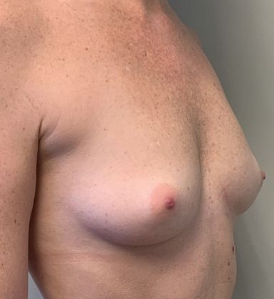Breast Augmentation: Case 23 - Breast Implants, Fairfield - Before
