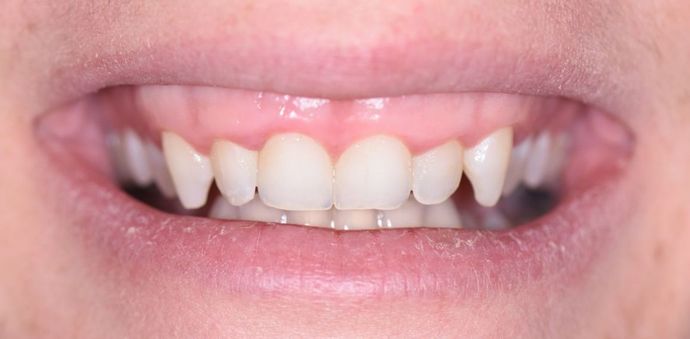 Gingivectomy Case 1 - Victoria, TX - Before