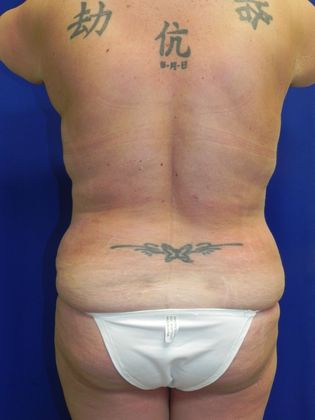 Body Mommy Make-Over: Case 6 (19509) - After