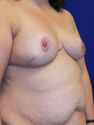 Body Mommy Make-Over: Case 6 (19509) - After