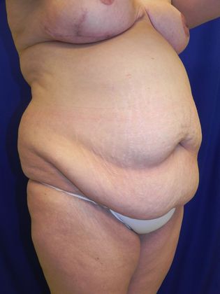 Body Mommy Make-Over: Case 6 (19509) - Before