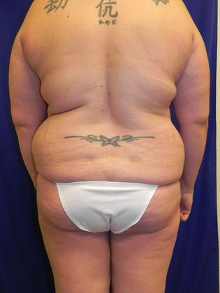 Body Mommy Make-Over: Case 6 (19509) - Before