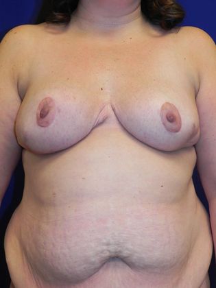 Body Diastasis Recti - Abdominal Muscle Separation: Case 2 (19509) - After