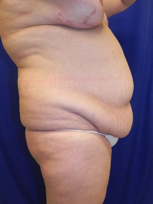 Body Diastasis Recti - Abdominal Muscle Separation Case 2 (19509) - Before