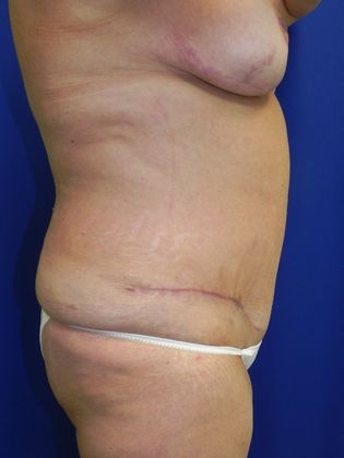 Body Diastasis Recti - Abdominal Muscle Separation Case 2 (19509) - After