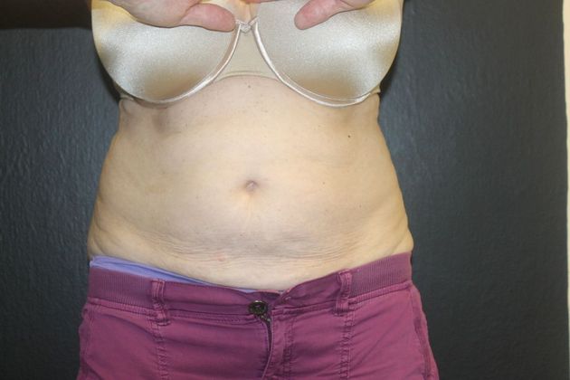 CoolSculpting® Case 8 - Before