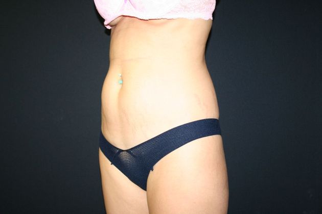 Abdominoplasty Case 17 - Before